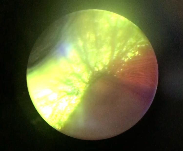 Descolamento de retina: sinais, diagnóstico e cuidados